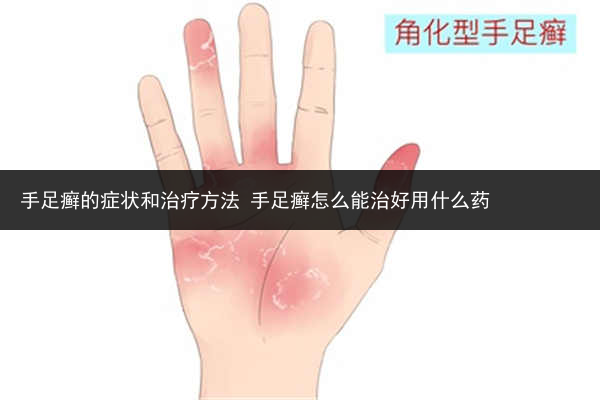 手足癬的癥狀和治療方法 手足癬怎么能治好用什么藥