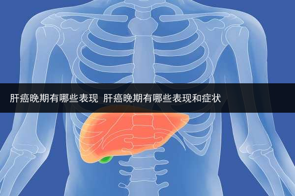 肝癌晚期有哪些表現 肝癌晚期有哪些表現和癥狀